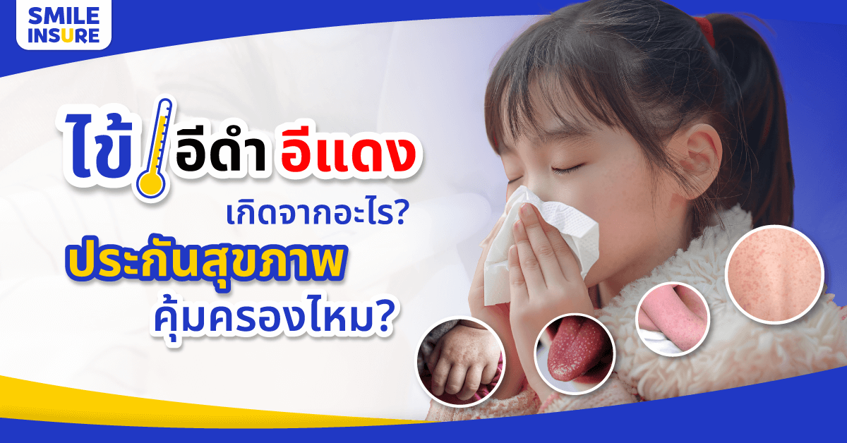 ไข้อีดำอีแดง เกิดจากอะไร? ประกันสุขภาพคุ้มครองไหม?